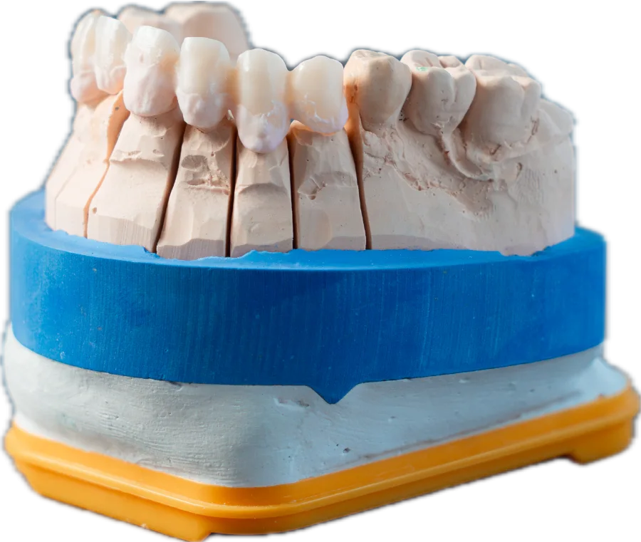 Gipsmodell mit Zahnkranz aus dem Dentallabor Starlab Dental